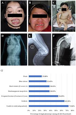 Genotypic and Phenotypic Analysis in Chinese Cohort With Autosomal Recessive Osteogenesis Imperfecta